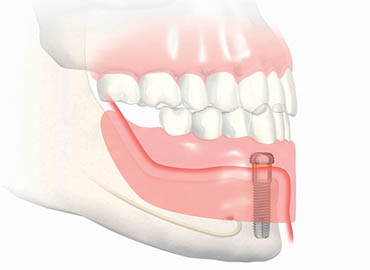 Implant dentaire Toulouse
